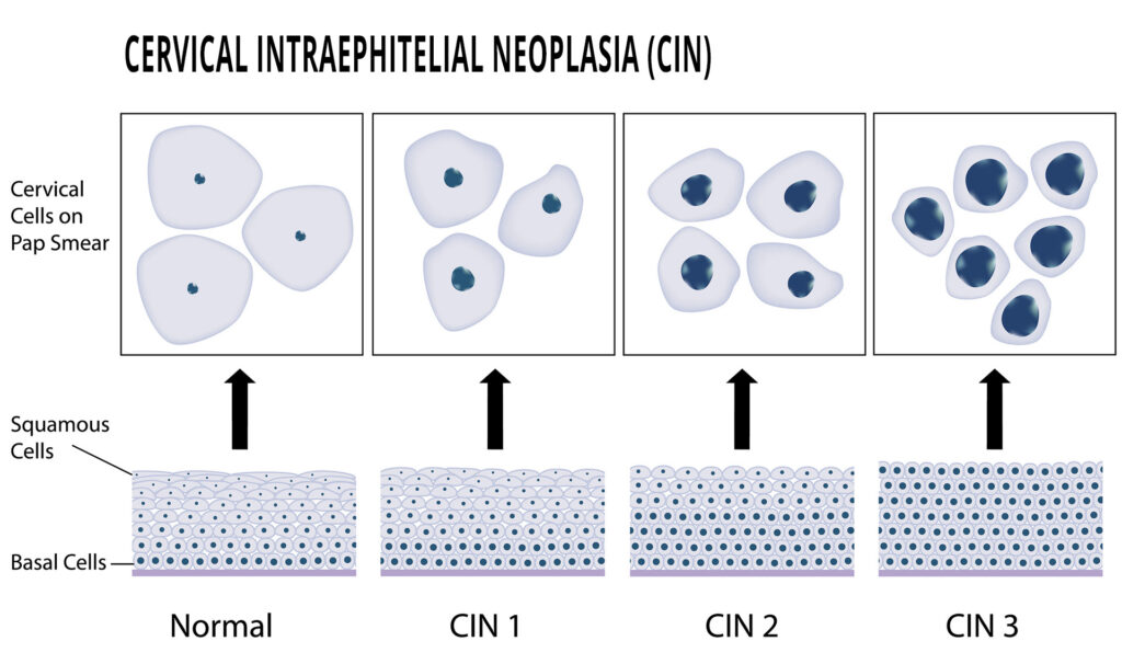 abnormal-pap-smear-test-cellsjpg