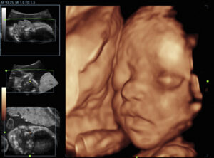 4d-ultrasound-picture